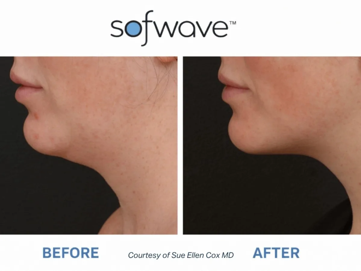 Sofwave™ Jawline Contouring